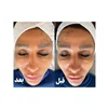 پیلینگ شیمیکال و خلاء اکسیژن با کربوکسی تراپی