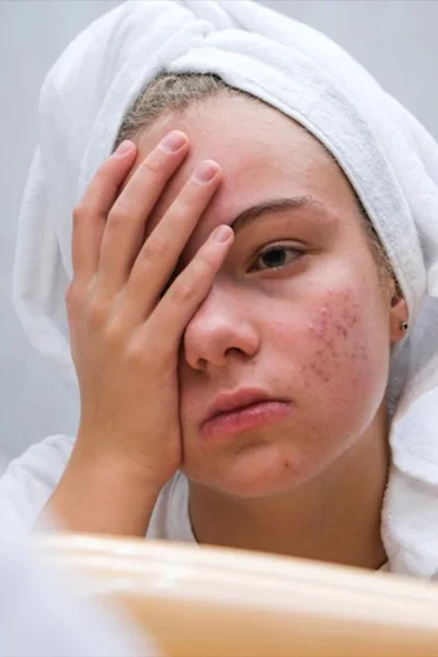 ریشهیابی مشکلات پوست: دلایل مشکلاتی مثل آکنه یا جوش، چطور میشه با اونها مقابله کرد