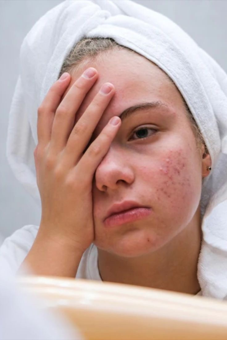 ریشه‌یابی مشکلات پوست: دلایل مشکلاتی مثل آکنه یا جوش، چطور می‌شه با اون‌ها مقابله کرد